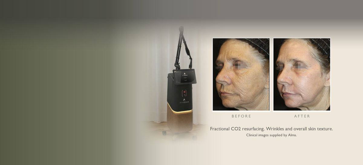 The Alma Hybrid laser at Eltham Cosmetic Clinic, with a fractional CO2 before and after