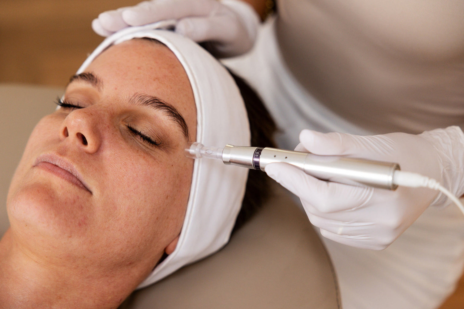 Acne Scarring Treatment Options