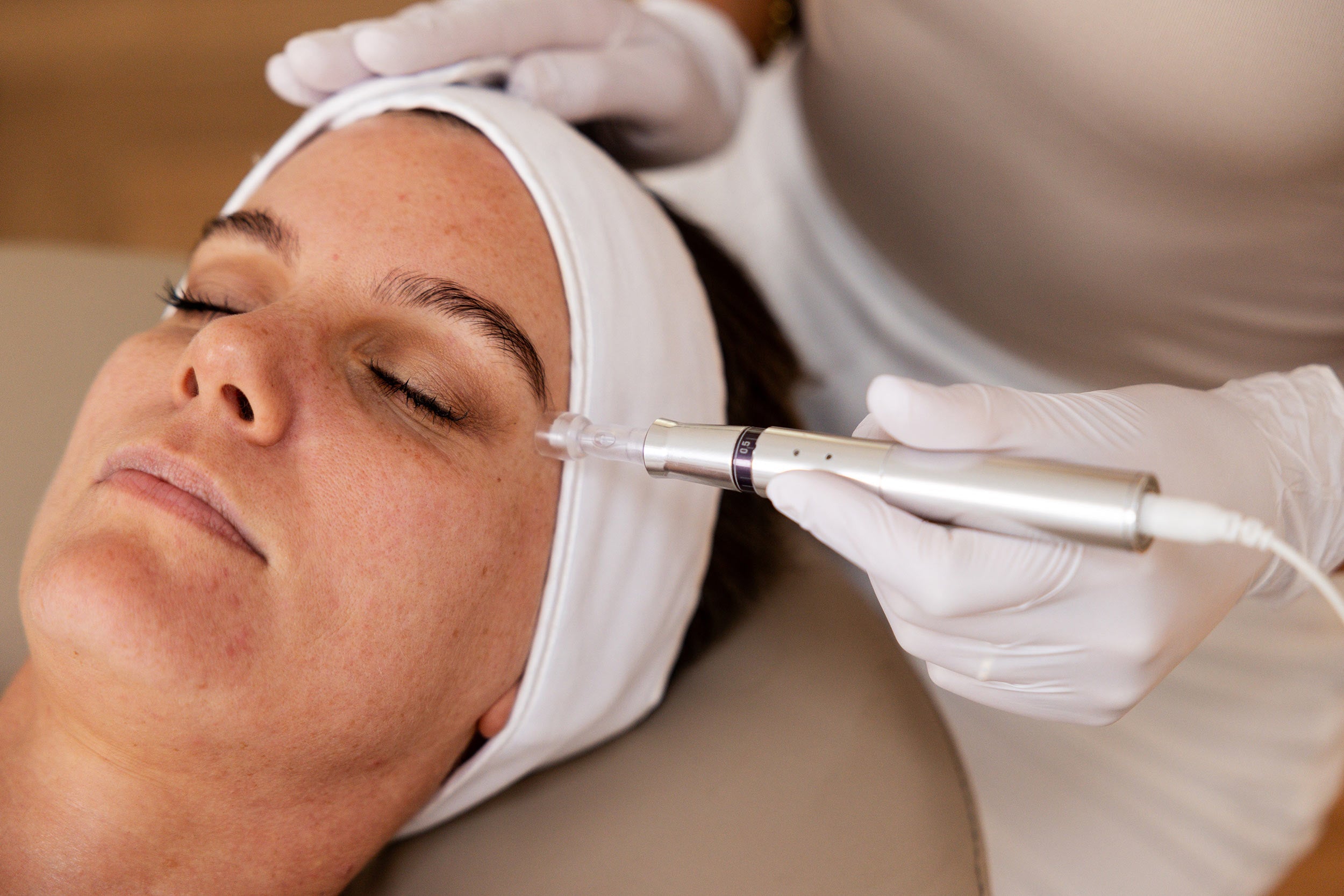 Acne Scarring Treatment Options
