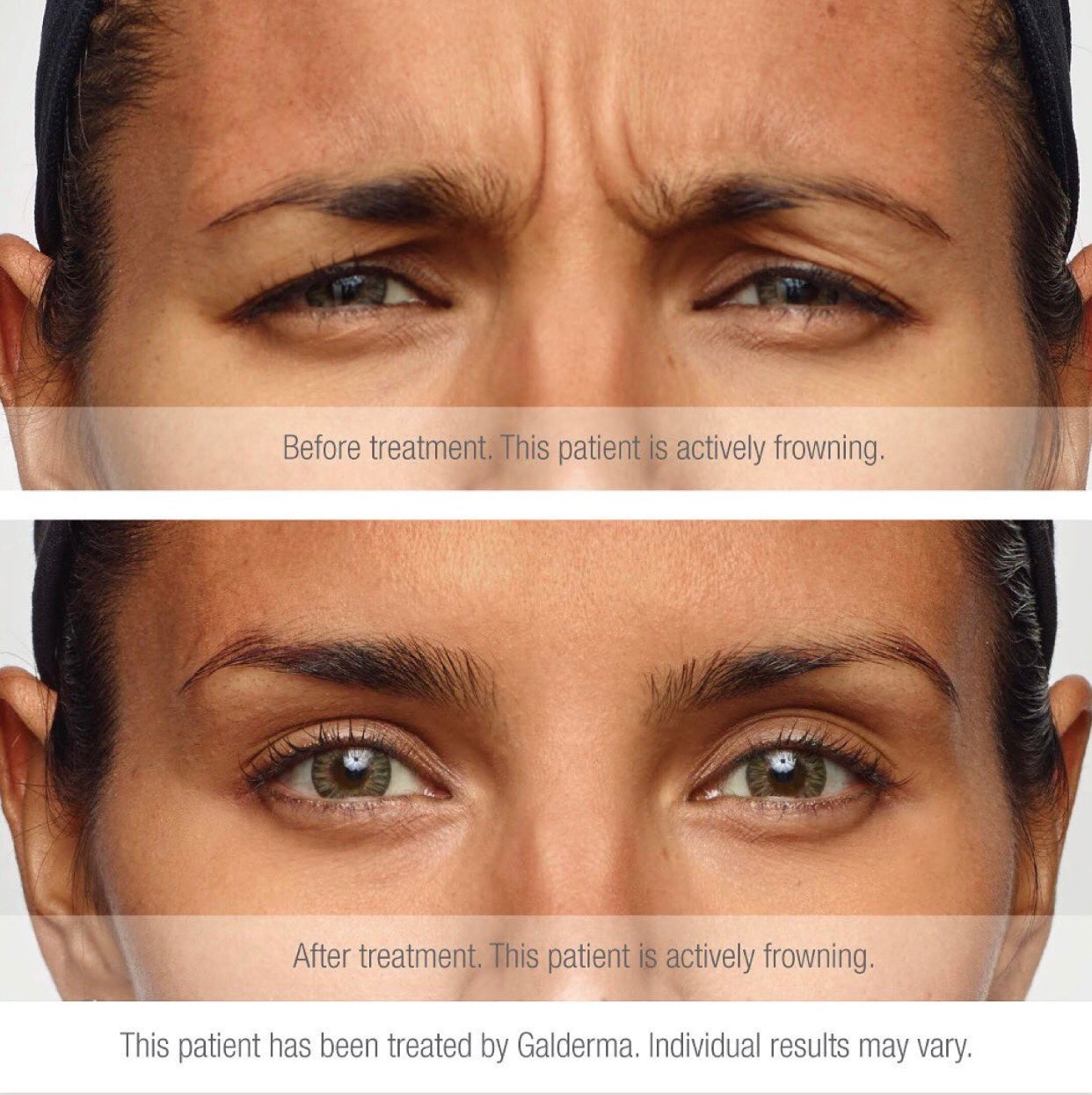 Anti-Wrinkle Injections
