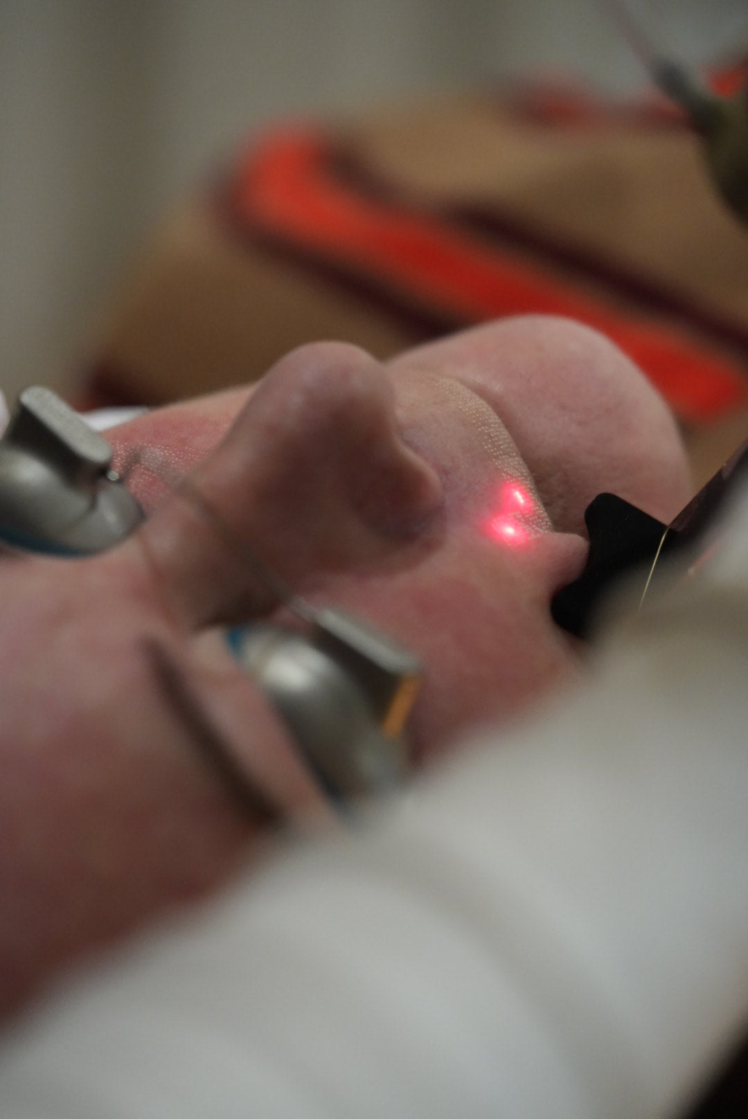 Close-up of laser skin treatment at Eltham Cosmetic Clinic