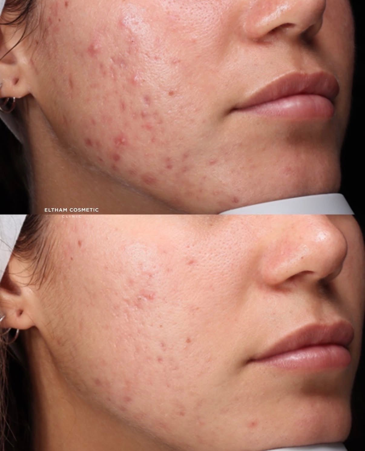 Laser for Acne Scars: What to Know.