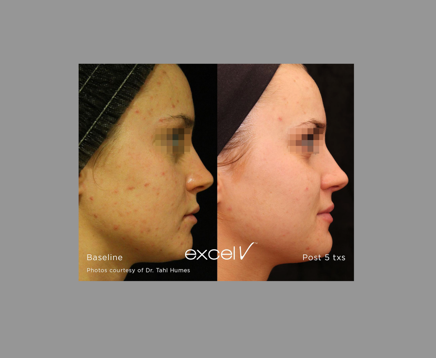 How to Choose the Best Clinic for Pigmentation Treatment