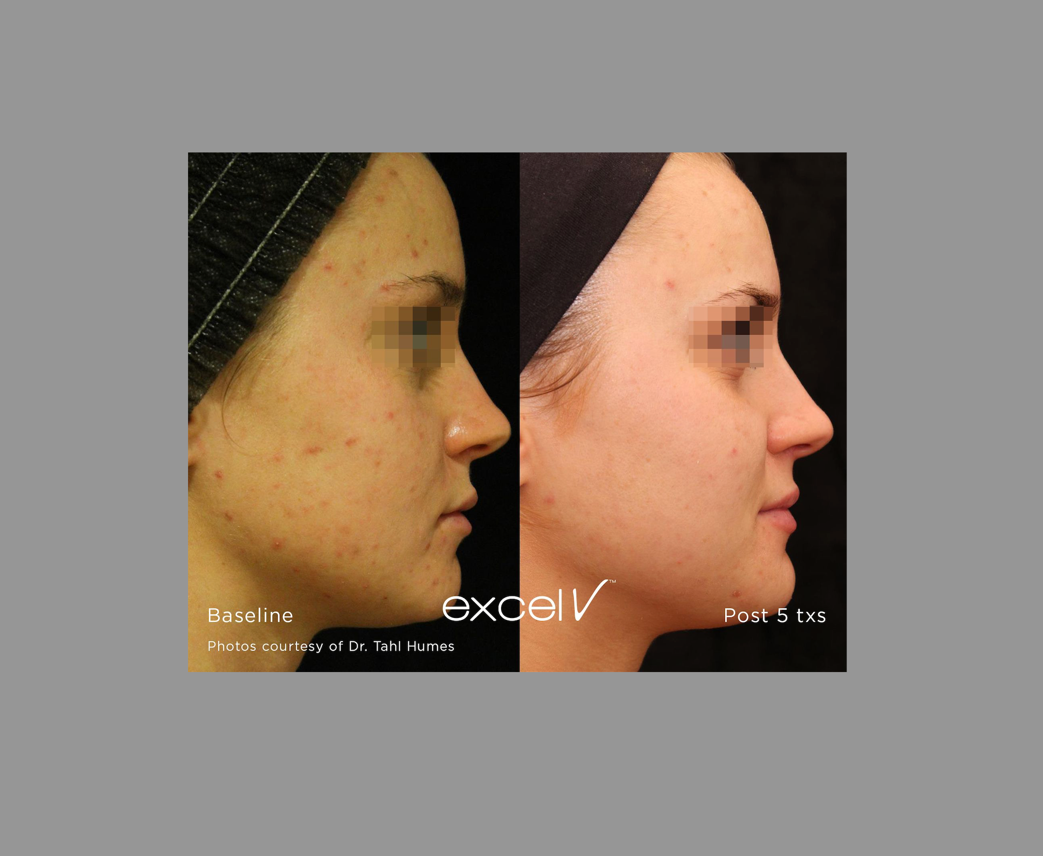 How to Choose the Best Clinic for Pigmentation Treatment