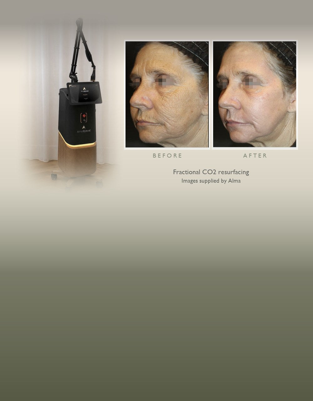 The Alma Hybrid laser at Eltham Cosmetic Clinic, with a fractional CO2 before and after