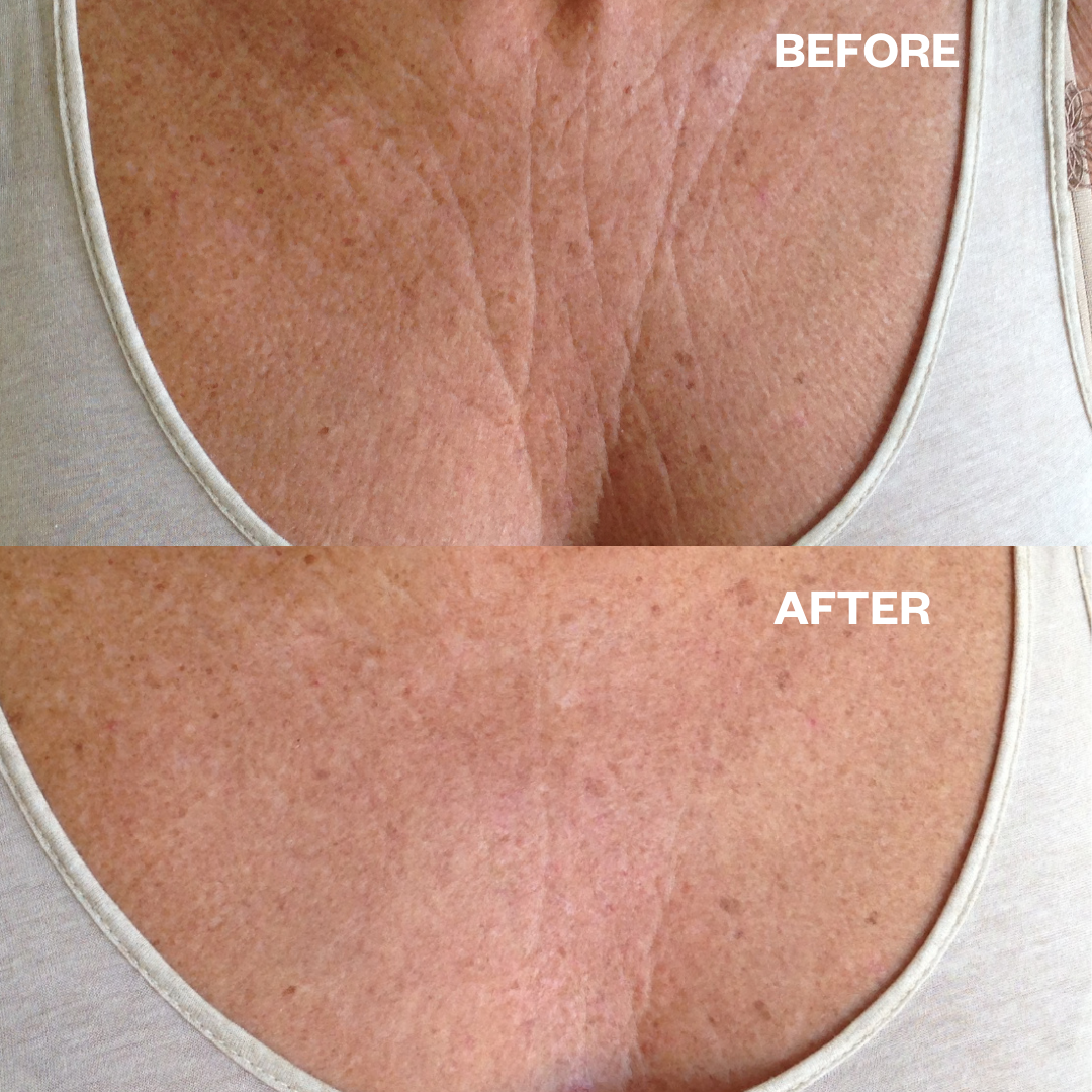 Chest Smoothing Kit