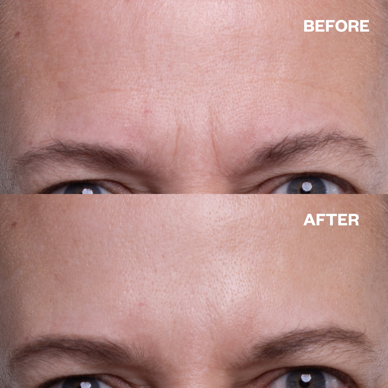 Forehead Smoothing Kit