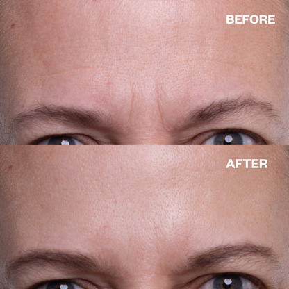 Forehead Smoothing Kit