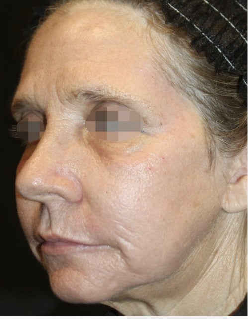 Wrinkles after fractional CO2 laser resurfacing