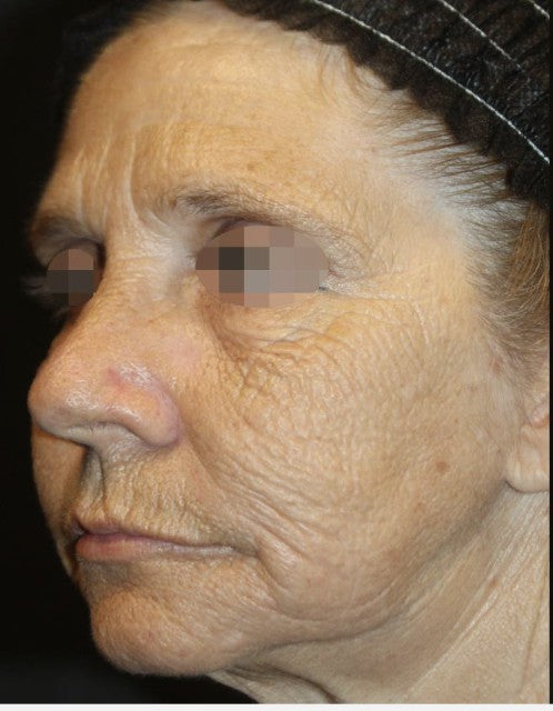 Wrinkles before fractional CO2 laser resurfacing