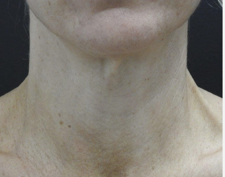 Neck after 1570nm laser treatment
