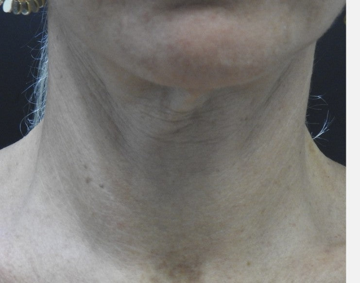 Neck before 1570nm laser treatment