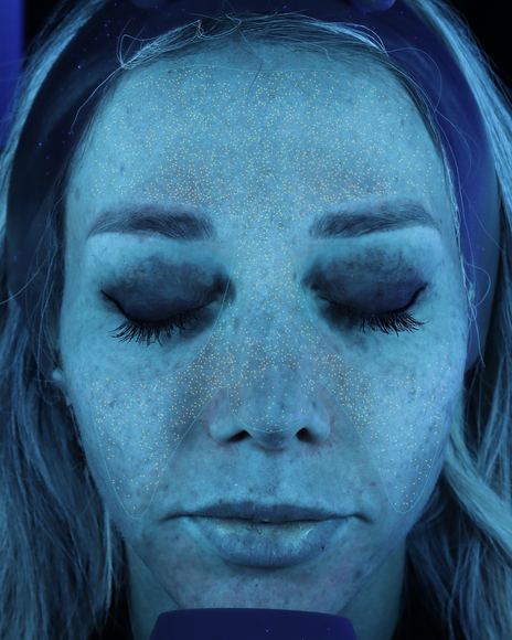VISIA oil and congestion scan