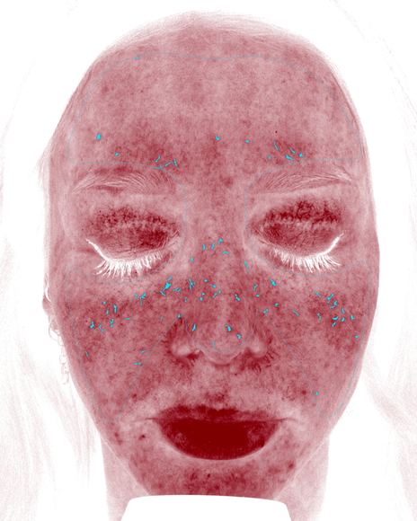 VISIA redness scan